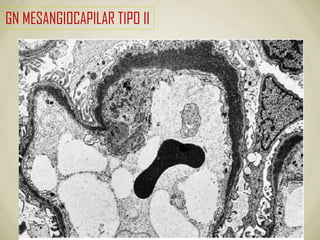 GN MESANGIOCAPILAR TIPO II
 