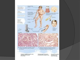 Hipertensión leve o moderada