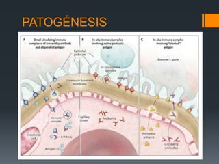 PATOGÉNESIS 
 