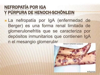 NEFROPATÍA POR IGA
Y PÚRPURA DE HENOCH-SCHÖNLEIN
 La nefropatía por IgA (enfermedad de
Berger) es una forma renal limitada de
glomerulonefritis que se caracteriza por
depósitos inmunitarios que contienen IgA
n el mesangio glomerular
 