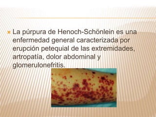  La púrpura de Henoch-Schönlein es una
enfermedad general caracterizada por
erupción petequial de las extremidades,
artropatía, dolor abdominal y
glomerulonefritis.
 