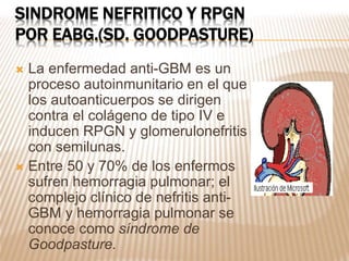 SINDROME NEFRITICO Y RPGN
POR EABG.(SD. GOODPASTURE)
 La enfermedad anti-GBM es un
proceso autoinmunitario en el que
los autoanticuerpos se dirigen
contra el colágeno de tipo IV e
inducen RPGN y glomerulonefritis
con semilunas.
 Entre 50 y 70% de los enfermos
sufren hemorragia pulmonar; el
complejo clínico de nefritis anti-
GBM y hemorragia pulmonar se
conoce como síndrome de
Goodpasture.
 