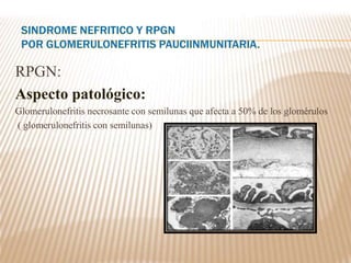 RPGN:
Aspecto patológico:
Glomerulonefritis necrosante con semilunas que afecta a 50% de los glomérulos
( glomerulonefritis con semilunas)
 