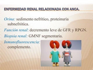 Orina: sedimento nefrítico, proteinuria
subnefrótica.
Función renal: decremento leve de GFR y RPGN.
Biopsia renal: GMNF segmentaria.
Inmunofluorescencia: escases o ausencia de
complemento.
 