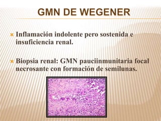  Inflamación indolente pero sostenida e
insuficiencia renal.
 Biopsia renal: GMN pauciinmunitaria focal
necrosante con formación de semilunas.
 
