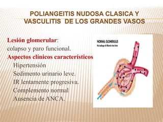 Lesión glomerular:
colapso y paro funcional.
Aspectos clínicos característicos:
Hipertensión
Sedimento urinario leve.
IR lentamente progresiva.
Complemento normal
Ausencia de ANCA.
POLIANGEITIS NUDOSA CLASICA Y
VASCULITIS DE LOS GRANDES VASOS
 