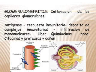 GLOMERULONEFRITIS: Inflamacion de los
capilares glomerulares.
Antigenos - respuesta inmunitaria- deposito de
complejos inmunitarios - infiltracion de
mononucleares- liber. Quimiocinas – prod.
Citocinas y proteasas – dañan
 