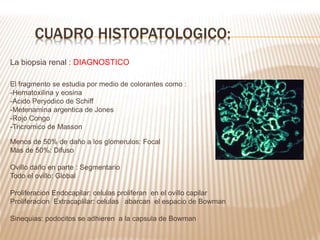 La biopsia renal : DIAGNOSTICO
El fragmento se estudia por medio de colorantes como :
-Hematoxilina y eosina
-Acido Peryodico de Schiff
-Metenamina argentica de Jones
-Rojo Congo
-Tricromico de Masson
Menos de 50% de daño a los glomerulos: Focal
Mas de 50%: Difuso
Ovillo daño en parte : Segmentario
Todo el ovillo: Global
Proliferacion Endocapilar: celulas proliferan en el ovillo capilar
Proliferacion Extracaplilar: celulas abarcan el espacio de Bowman
Sinequias: podocitos se adhieren a la capsula de Bowman
CUADRO HISTOPATOLOGICO:
 