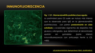 NEFROLOGIA CLINICA: Glomerulonefritis postestrectococica | PDF