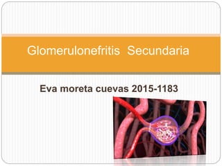 Eva moreta cuevas 2015-1183
Glomerulonefritis Secundaria
 