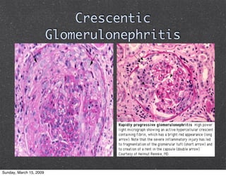 Glomerulonephritis