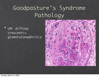 Glomerulonephritis