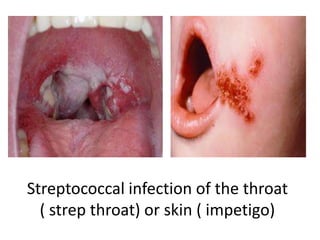 Streptococcal infection of the throat
  ( strep throat) or skin ( impetigo)
 