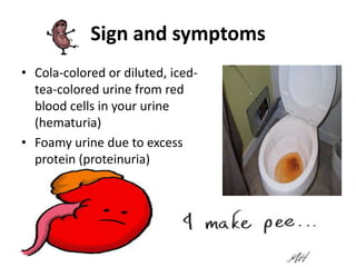 Sign and symptoms
• Cola-colored or diluted, iced-
  tea-colored urine from red
  blood cells in your urine
  (hematuria)
• Foamy urine due to excess
  protein (proteinuria)
 