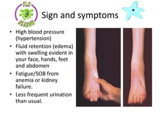 Sign and symptoms
• High blood pressure
  (hypertension)
• Fluid retention (edema)
  with swelling evident in
  your face, hands, feet
  and abdomen
• Fatigue/SOB from
  anemia or kidney
  failure.
• Less frequent urination
  than usual.
 