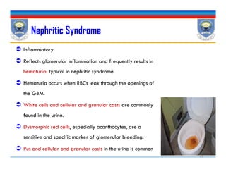 Nephritic Syndrome
 Inflammatory
 Reflects glomerular inflammation and frequently results in
hematuria: typical in nephritic syndrome
 Hematuria occurs when RBCs leak through the openings of
the GBM.
 White cells and cellular and granular casts are commonly
found in the urine.
 Dysmorphic red cells, especially acanthocytes, are a
sensitive and specific marker of glomerular bleeding.
 Pus and cellular and granular casts in the urine is common
 Inflammatory
 Reflects glomerular inflammation and frequently results in
hematuria: typical in nephritic syndrome
 Hematuria occurs when RBCs leak through the openings of
the GBM.
 White cells and cellular and granular casts are commonly
found in the urine.
 Dysmorphic red cells, especially acanthocytes, are a
sensitive and specific marker of glomerular bleeding.
 Pus and cellular and granular casts in the urine is common
19
 