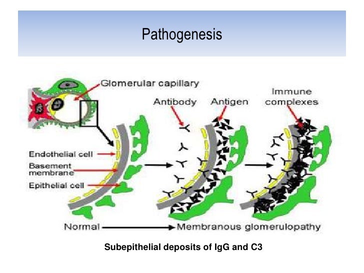 Glomerulonephritis1,2