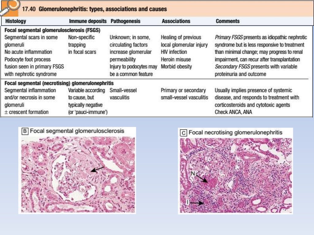 Glomerulonephritis and nephrotic syndrome