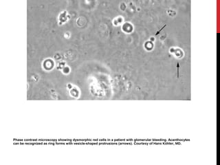 16
Phase contrast microscopy showing dysmorphic red cells in a patient with glomerular bleeding. Acanthocytes
can be recognized as ring forms with vesicle-shaped protrusions (arrows). Courtesy of Hans Köhler, MD.
 