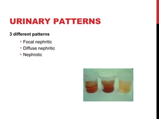 20
URINARY PATTERNS
3 different patterns
• Focal nephritic
• Diffuse nephritic
• Nephrotic
 