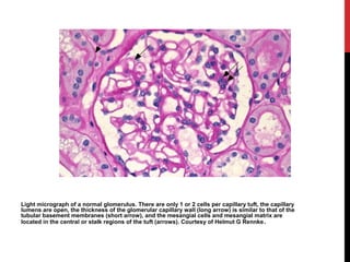 4
Light micrograph of a normal glomerulus. There are only 1 or 2 cells per capillary tuft, the capillary
lumens are open, the thickness of the glomerular capillary wall (long arrow) is similar to that of the
tubular basement membranes (short arrow), and the mesangial cells and mesangial matrix are
located in the central or stalk regions of the tuft (arrows). Courtesy of Helmut G Rennke.
 