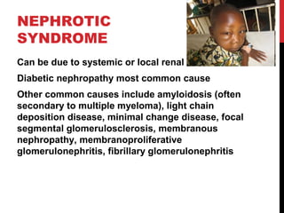 43
NEPHROTIC
SYNDROME
Can be due to systemic or local renal disease
Diabetic nephropathy most common cause
Other common causes include amyloidosis (often
secondary to multiple myeloma), light chain
deposition disease, minimal change disease, focal
segmental glomerulosclerosis, membranous
nephropathy, membranoproliferative
glomerulonephritis, fibrillary glomerulonephritis
 