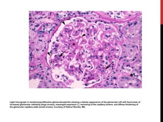 5
Light micrograph in membranoproliferative glomerulonephritis showing a lobular appearance of the glomerular tuft with focal areas of
increased glomerular cellularity (large arrows), mesangial expansion (*), narrowing of the capillary lumens, and diffuse thickening of
the glomerular capillary walls (small arrows). Courtesy of Helmut Rennke, MD.
 