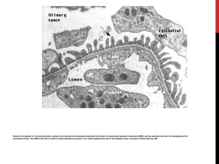 6
Electron micrograph of a normal glomerular capillary loop showing the fenestrated endothelial cell (Endo), the glomerular basement membrane (GBM), and the epithelial cells with its interdigitating foot
processes (arrow). The GBM is thin and no electron dense deposits are present. Two normal platelets are seen in the capillary lumen. Courtesy of Helmut Rennke, MD.
 