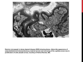 7
Electron micrograph in dense deposit disease (DDD) showing dense, ribbon-like appearance of
subendothelial and intramemb...