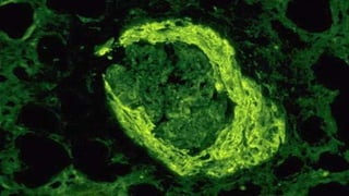 Crescentic Rpgn Crescentric Glomerulonephritis (RPGN) | PPTX
