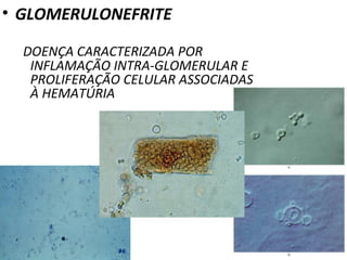 • GLOMERULONEFRITE
DOENÇA CARACTERIZADA POR
INFLAMAÇÃO INTRA-GLOMERULAR E
PROLIFERAÇÃO CELULAR ASSOCIADAS
À HEMATÚRIA

 