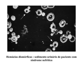 Hemácias dismórficas : sedimento urinário de paciente com
síndrome nefrítica

 