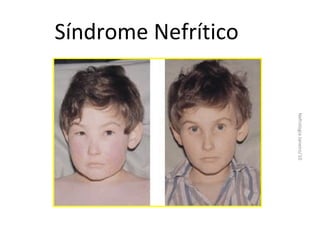 Síndrome Nefrítico

Nefrologia Janeiro/10

 