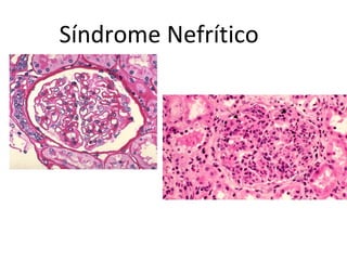 Síndrome Nefrítico

Nefrologia Janeiro/10

 