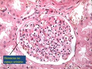 Hemácias no
espaço urinário

 