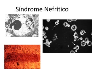 Síndrome Nefrítico

Nefrologia Janeiro/10

 