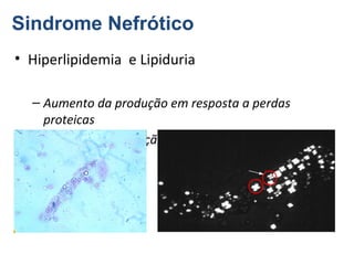Sindrome Nefrótico
• Hiperlipidemia e Lipiduria
– Aumento da produção em resposta a perdas
proteicas
– Aumento da excreção de lipides

 