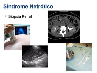 Sindrome Nefrótico
• Biópsia Renal

 