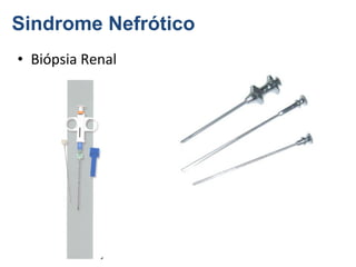 Sindrome Nefrótico
• Biópsia Renal

 