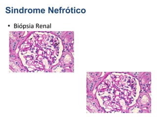 Sindrome Nefrótico
• Biópsia Renal

 