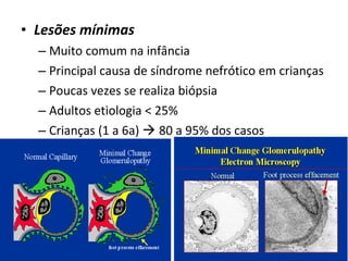 • Lesões mínimas
– Muito comum na infância
– Principal causa de síndrome nefrótico em crianças
– Poucas vezes se realiza biópsia
– Adultos etiologia < 25%
– Crianças (1 a 6a)  80 a 95% dos casos

 