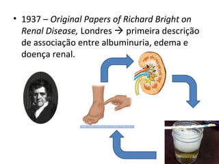 • 1937 – Original Papers of Richard Bright on
Renal Disease, Londres  primeira descrição
de associação entre albuminuria, edema e
doença renal.

 