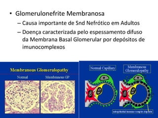• Glomerulonefrite Membranosa
– Causa importante de Snd Nefrótico em Adultos
– Doença caracterizada pelo espessamento difuso
da Membrana Basal Glomerular por depósitos de
imunocomplexos

 