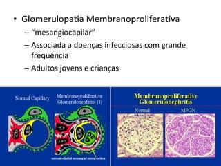 • Glomerulopatia Membranoproliferativa
– “mesangiocapilar”
– Associada a doenças infecciosas com grande
frequência
– Adultos jovens e crianças

 
