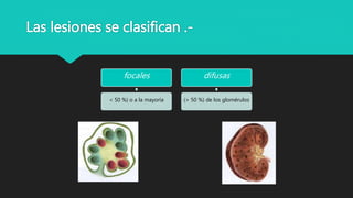Las lesiones se clasifican .-
focales
< 50 %) o a la mayoría
difusas
(> 50 %) de los glomérulos
 