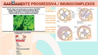 DOENÇA POR ANTICORPOS ANTIMEMBRANA BASAL GLOMERULAR
o Anticorpos direcionados ao colágeno da membrana basal glomerular
o Anticorpo anti- MBG e imunofluorescência na microscopia dão o diagnóstico
o GN isolada / síndrome de Goodpasture ou a gn pulmão-rim com hemorragia pulmonar
o Necessidade de diálise é um mal prognostico da evolução da doença
o Plasmaférese é o tratamento inicial *
o Crescentes >50% da densidade glomerular tem evolução desfavorável
o Hemorragia pulmonar tratada com corticóides em doses imunossupressoras
o 10-15% associação com cruzamento de pANCA contra MPO e vasculite sistêmica
RAPIDAMENTE PROGRESSIVA / IMUNOCOMPLEXOS
 