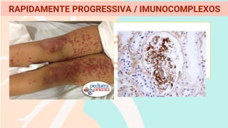 PÚRPURA DE HENOCH-SCHONLEIN
o Vasculite generalizada provocada por depósitos de IgA
o Sintomas de púrpuras, dor abdominal, miosite ,artralgia e nefropatia por depósito
o Acomete principalmente crianças
o Sintomas de hematúria e proteinúria
o Aumento sérico de IgA é o critério diagnóstico
o Biópsia renal é útil no diagnóstico e acompanhamento
o Tratamento com sintomáticos e regressão espontânea
RAPIDAMENTE PROGRESSIVA / IMUNOCOMPLEXOS
 