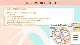DOENÇA POR LESÃO MÍNIMA
o 10-15% em adultos e 70-90% das crianças
o P.A normal
o TFG levemente reduzida
o Sumário de urina com proteinúria e/ou hematúria microscópica
o Associação com quadros de IVAS e uso de AINES
o Biópsia alteração podocitária apenas
o Remissão espontânea / uso de corticóides
SÍNDROME NEFRÓTICA
 