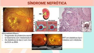 NEFROPATIA DIABÉTICA
o Trata-se da causa mais comum de SN
o Embora a duração prévia do diabetes melito (DM) seja variável, a proteinúria no DM tipo 1 pode
surgir em 10 a 15 anos após o início da doença
o Insuficiência renal no decorrer de 3 a 5 anos
o A retinopatia é quase universal em diabéticos com nefropatia, tanto que sua ausência deve
levar à consideração de outra lesão glomerular
o Proteinúria, hipertensão progressiva e insuficiência renal progressiva
o Alterações patológicas incluem esclerose mesangial, glomeruloesclerose difusa e/ou nodular
(Kimmelstiel-Wilson)
o Progressão da proteinúria assintomática até 25g/24h com DRT
o O tratamento com inibidoresda ECA retarda o inicio da nefropatia e de DRT em diabéticos tipo l
o Os diabéticos do tipo 2 com microalbuminúriaou proteinúria podem ser tratados com inibidores
da ECA ou BRA
SÍNDROME NEFRÓTICA
 