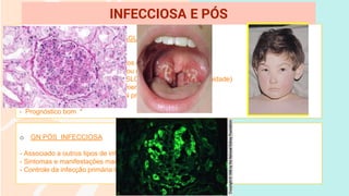 o GN PÓS ESTREPTOCÓCICA AGUDA
- Mais comum na infância
- Infeccção por Streptos B-hemolíticos e cepas nefritogênica
- Diagnóstico com Swab orofaringe ou raspado de pele
- Anticorpos antiestreptocócicos ( ASLO, Anti-DNA, Anti-hialuronidade)
- Consumo de proteínas do complemento
- Biópsia renal com evidência de GN proliferativa difusa
- Tratamento sintomáticos e DHE
- Prognóstico bom *
INFECCIOSA E PÓS
o GN PÓS INFECCIOSA
- Associado a outros tipos de infecções
- Sintomas e manifestações mais leves
- Controle da infecção primária leva à resolução do quadro
 